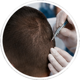 FUE hair transplant Kusadasi