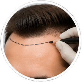 Frontal hairline design Kusadasi